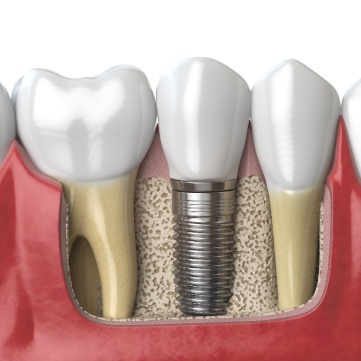 Digital illustration of an implant denture