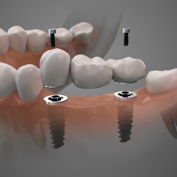 Digital illustration of an implant bridge