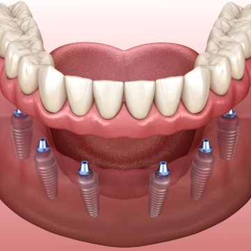 Digital illustration of implant dentures