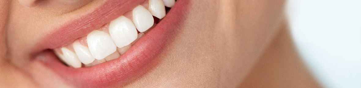 Woman smiling with veneers