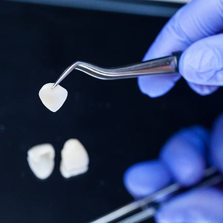 Dentist holding a veneer with tweezers